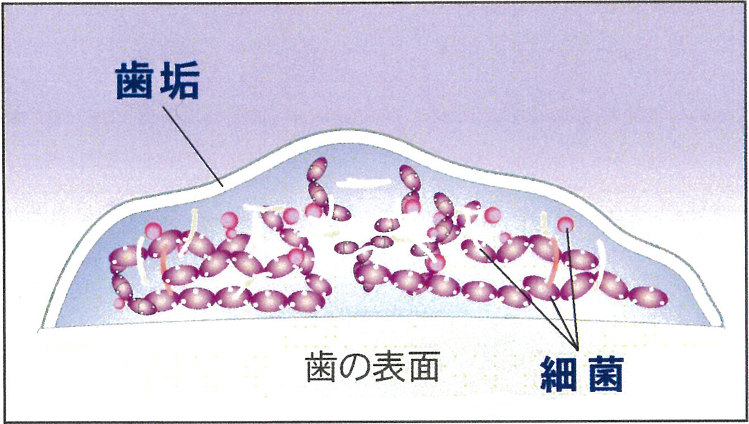 歯垢と細菌