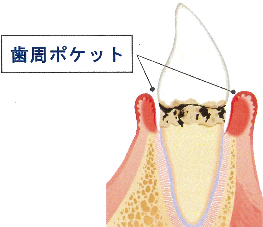 歯周ポケット