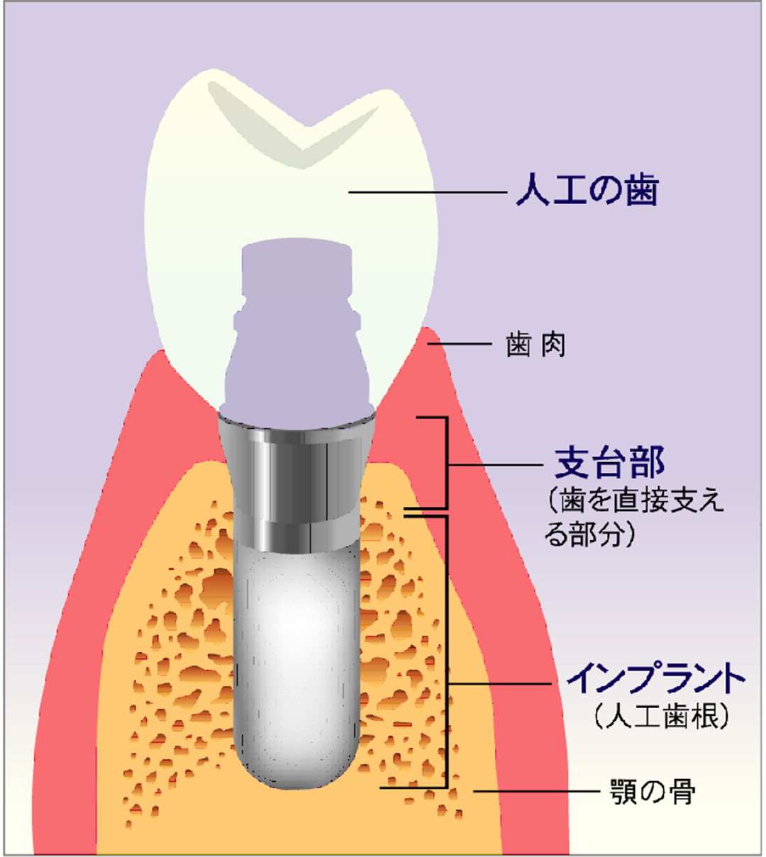 インプラント